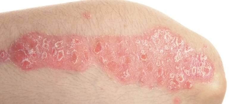 nb psoriasis textpart 1