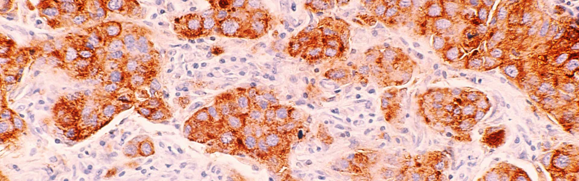 ROR1-肿瘤治疗策略多样化靶点