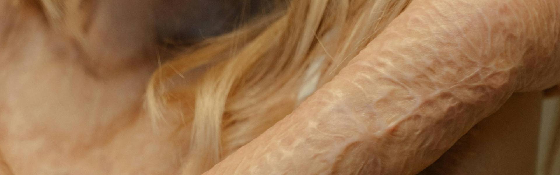 组织纤维化不可逆转进程或可终结