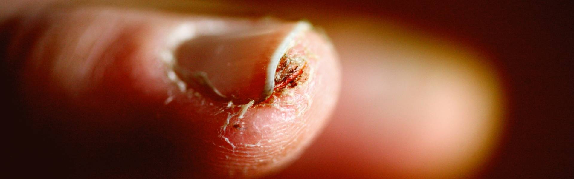 缠绵不肯愈，瘙痒痛难消。 湿疹治疗何去何从？