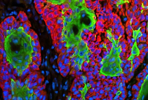 肿瘤免疫相关靶点MICA/B成药策略及研究