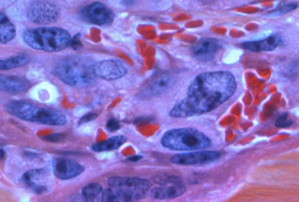 自报告型光动力纳米抗体：大体积肿瘤精准医疗新范式