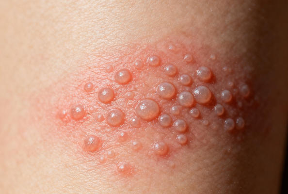 靶向HSV-gB蛋白纳米抗体，再证破局疱疹病毒难治困境